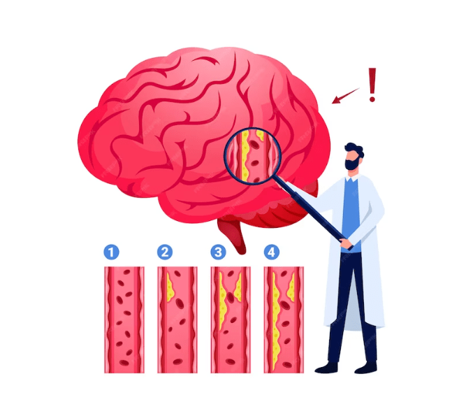 Neurological Complications of Lyme Disease