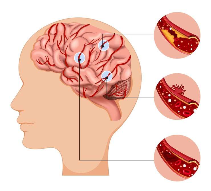 Olivopontocerebellar Atrophy