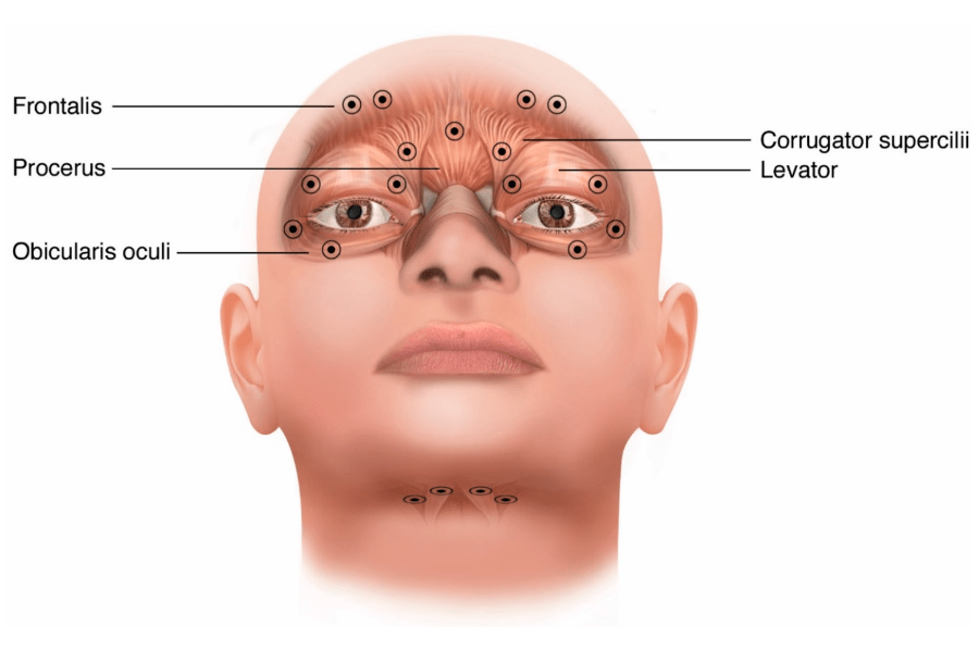 Benign Essential Blepharospasm