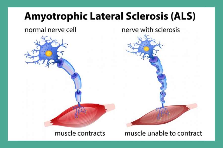 What is ALS – Amyotrophic lateral sclerosis? Treatment for ALS