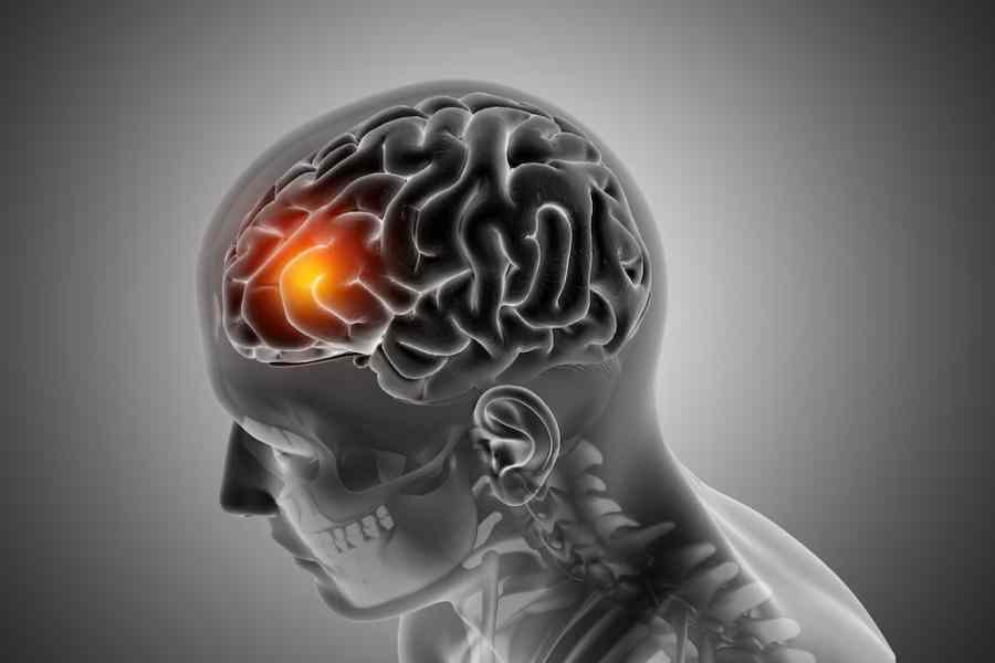 Stroke Prevention and Recovery - BNC - Blog