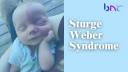 Sturge-Weber Syndrome