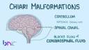 Chiari Malformation