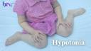 Hypotonia